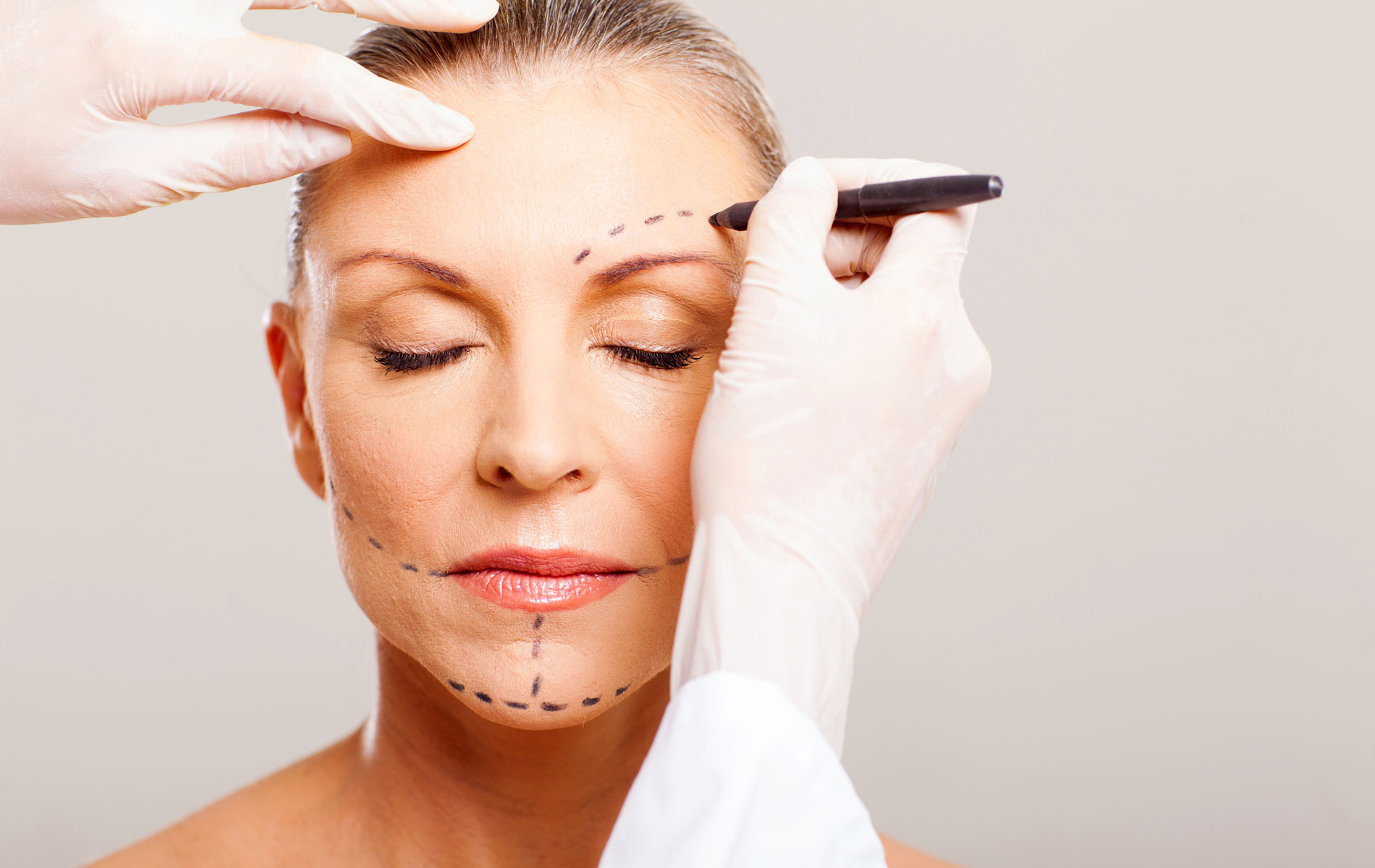 Face Lift/Rhytidectomy: What's Involved