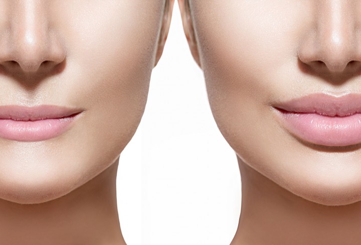 Lip Augmentation: What's Involved in Plumping Your Pout